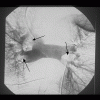 Embolie pulmonaire bilatrale avec caillots proximaux