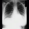  Pneumonie franche lobaire aige  pneumocoque