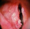 Cancer unilatral de la corde vocale